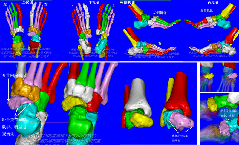 骨科诊疗迈入精准医疗时代，3D技术为骨科手术“保驾护航”