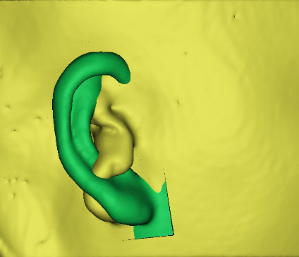 小耳畸形怎么办？这有一份三维数字化治疗方案请签收！