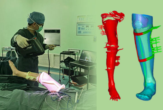 下肢复杂畸形微创、三维精准矫正